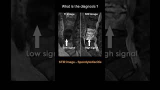 STIR image – Spondylodiscitis Quiz 16 radiologychannel007 [upl. by Musette786]