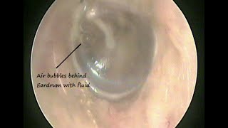 Otoendoscopy  Fluid behind Eardrum  Serous Otitis media  Glue ear  due to cold amp allergy [upl. by Vladamar96]