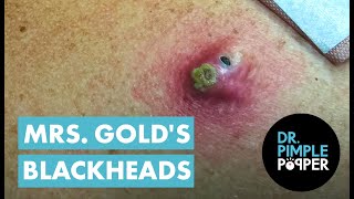 Mrs Golds Back Blackhead Extraction Session  Addressing the Inflamed One [upl. by Cita532]