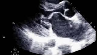 Mitral Stenosis  Echo Clip [upl. by Kennie]