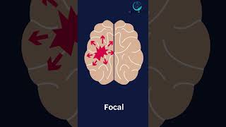 Types of Seizures seizures fits backpain brain cervicalpain headache pain spine migraine [upl. by Anoik]