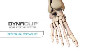 DynaClip® Bone Fixation System Animation [upl. by Nepets]