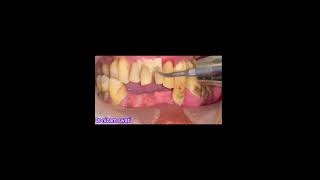 dental scaling [upl. by Janine]