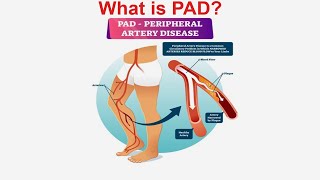 Mastering Vascular Health All you Need to Know About Peripheral Arterial Disease PAD Gujarati [upl. by Divadnahtanoj]