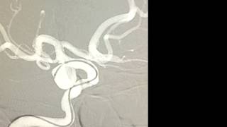 Endovascular coil embolization of unruptured posterior communicating artery aneurysm [upl. by Etnahc627]