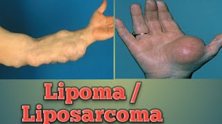 Lipoma  Liposarcoma Cancer Pathology Oncology Cancer [upl. by Hotchkiss]