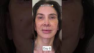 INSANE 2Week Facelift Healing and Recovery Process [upl. by Roldan138]