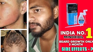 India no1 minoxidil review  mintop minoxidil for beard growth  mintop minoxidil 5 beard growth [upl. by Lahsiv863]