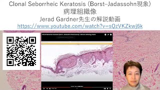 clonal seborrheic keratosisの病理組織像 [upl. by Coray]