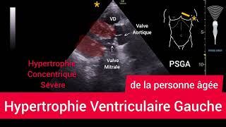 Hypertrophie Ventriculaire Gauche HVG Left Ventricular Hypertrophy Échographie [upl. by Remy]