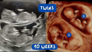 Cute Ultrasound Video of Twins at 11 Weeks Gestation  Scan of the Week [upl. by Selby811]