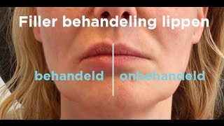 Lippen opvullen met fillers en canule  Da Vinci lip treatment [upl. by Anatola383]