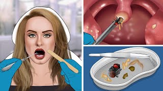 ASMR Remove The Fly amp Tonsil Stone From Adeles Throat [upl. by Munt]