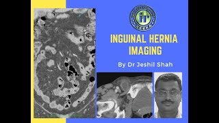 TMT Inguinal Hernia Imaging by Dr Jeshil Shah [upl. by Buff]