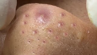 Big Cystic Acne Blackheads Extraction Blackheads amp Milia Whiteheads Removal Pimple Popping  8251 [upl. by Storm]