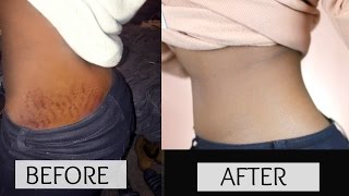 HOW TO GET RID OF STRETCH MARKS amp SCARS FAST [upl. by Alyl274]