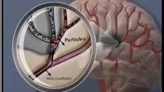 Endovascular MMA embolization for chronic SDH Endovascular Neurosurgery Minimally invasive [upl. by Adnawat]