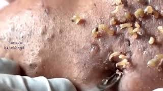 Acne amp Blackhead Treatment on his foreheadBlackhead Removal on forehead  Remove Blackhead [upl. by Anerrol]