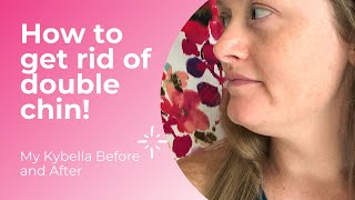 My Kybella Before and After  How to Get Rid of Double Chin [upl. by Selig390]