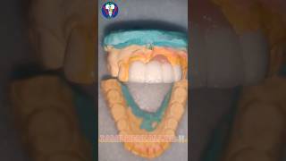 Ceramic Teeth  Upper Anterior  Maxillary Insicor  PFM  Tamil Dental Lab  tamildentist shorts🦷 [upl. by Tini]