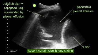 Lung ultrasound  Simple pleural effusion VS hydropneumothorax [upl. by Iahcedrom288]