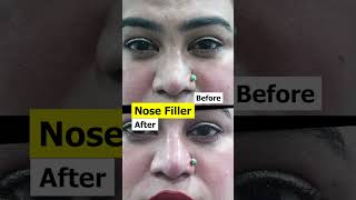 Instant Nose Transformation with Dermal Filler 💉✨ NoseFillerquot [upl. by Nohj]