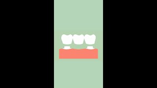 Dental Implant vs Bridge [upl. by Lemart]