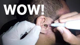 Mans Earwax Buildup Removal with Hydrogen Peroxide Application [upl. by Haidedej773]