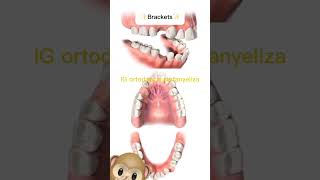 Extractions in orthodontics orthodontictips ортодонтия kieferorthopädie ortodonzia orthodontie [upl. by Conyers]