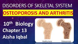 Disorder of Skeletal system Class 10 [upl. by Kamin751]