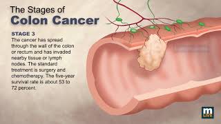 Stages of Colon Cancer [upl. by Nylikcaj]