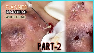 Big Cystic Acne Blackheads Extraction Blackheads amp Milia Whiteheads Removal Pimple Popping [upl. by Jeanette]