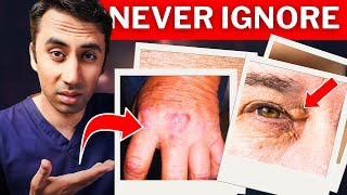 Doctor Explains 4 Skin Signs of High Cholesterol Real Life Photos [upl. by Yelyr]