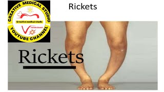 Rickets diseasevitamin DCalcium sign amp symptoms Rickets [upl. by Wilkison]