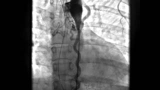 Coarctation of Aorta with Large Collaterals AP view [upl. by Ulland615]