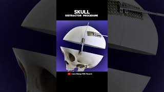 Skull distractor Procedure Animation [upl. by Damien]