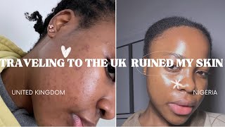 TRAVELING TO THE UK RUINED MY SKIN  How I Repaired my Damaged Oily Acne Prone Skin [upl. by Oicirtap]