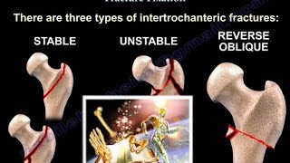 Intertrochanteric Hip Fractures  Everything You Need To Know  Dr Nabil Ebraheim [upl. by Alger278]