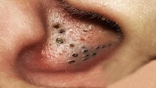 Big Cystic Acne Blackheads Extraction Blackheads amp Milia Whiteheads Removal Pimple Popping  3794 [upl. by Berna]