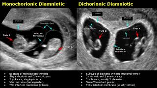 Fetal Twins Ultrasound Normal Vs Abnormal  MonochorionicDichorionicDiamnioticMonoamniotic USG [upl. by Gnik]