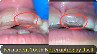 If your Childs Permanent tooth is not coming out  Watch This Front Permanent tooth not coming [upl. by Sualokin]