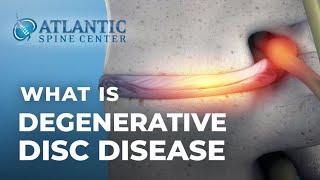 What Is Lumbar Degenerative Disc Disease  Intervertebral Disc Height Loss [upl. by Rothwell]