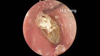 Ear wax removalFungus cleaning 耳垢清除和真菌清理20230906 [upl. by Ddahc478]