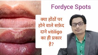 Fordyce Spots  क्या होंठों पर होने वाले सफ़ेद दाने vitiligo का ही प्रकार है vitiligo Leucoderma [upl. by Lundquist928]