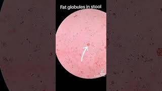 Fat globules in stool [upl. by Toland]