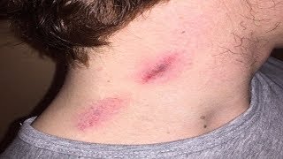 How To Make Hickies Go Away  10 Fastest Way To Get Rid Hickies Quickly [upl. by Keldah]