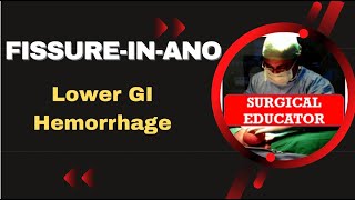 FISSURE IN ANO How To DIAGNOSE amp TREAT Lower GI Hemorrhage [upl. by Simpson]