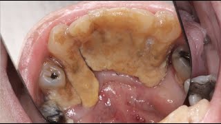 MASSIVE Calculus Buildup  Severe Gum Disease Case [upl. by Stanleigh686]