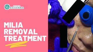 Milia Removal Treatment Ada Di Klinik Avicenna [upl. by Niawat]