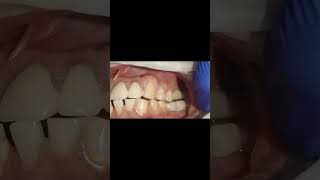 Checking lateral inference for basal implant molar bridge milled in GCam [upl. by Bor249]